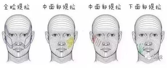 面部提升术
