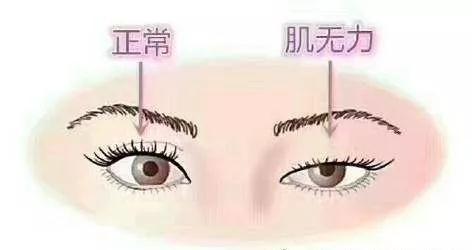 双眼皮手术