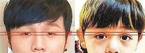 双眼皮手术