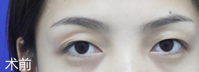 双眼皮手术