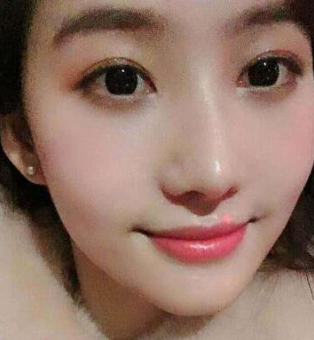 隆鼻手术