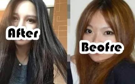 自体脂肪填充术
