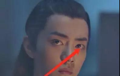 双眼皮手术