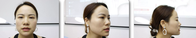 玻尿酸