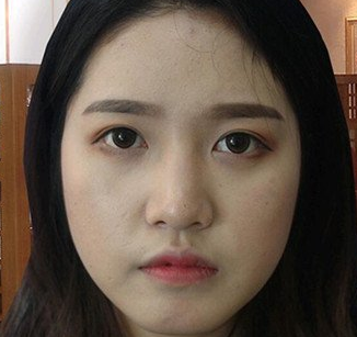 隆鼻手术
