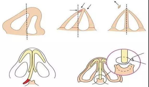 隆鼻手术