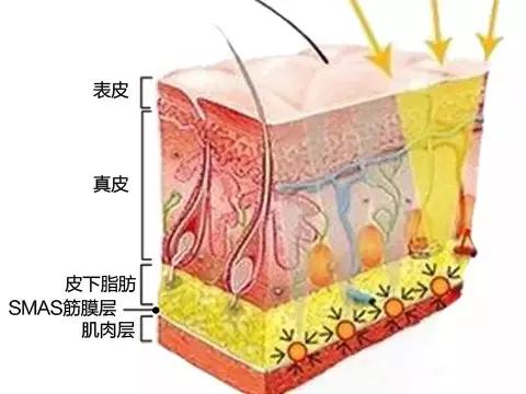 面部提升术