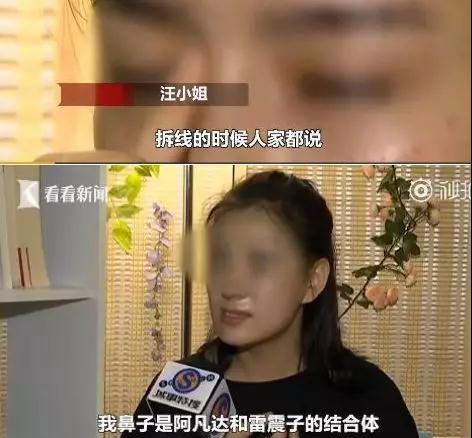 隆鼻手术