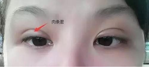 双眼皮手术