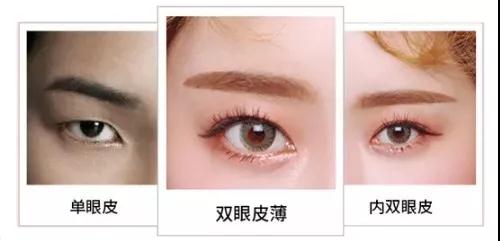 双眼皮手术