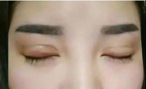 双眼皮手术