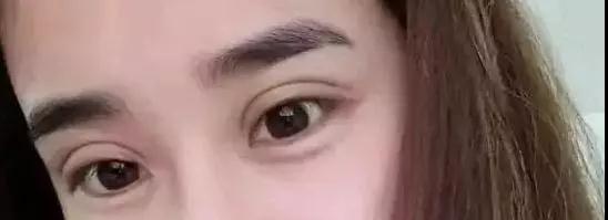 双眼皮手术