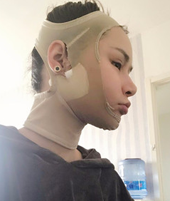 超声波瘦脸
