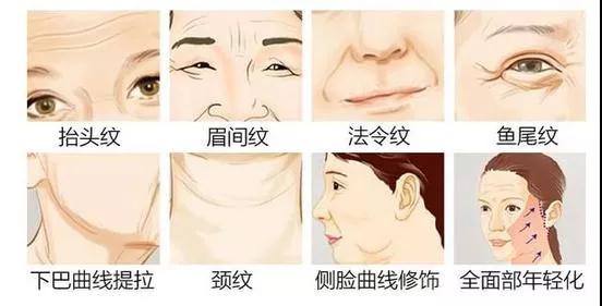 面部提升术