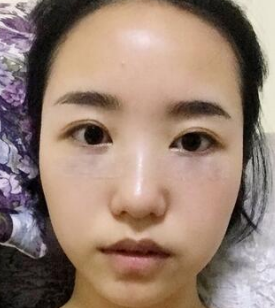 超声波去眼袋