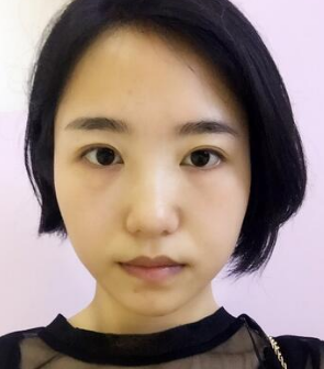 超声波去眼袋