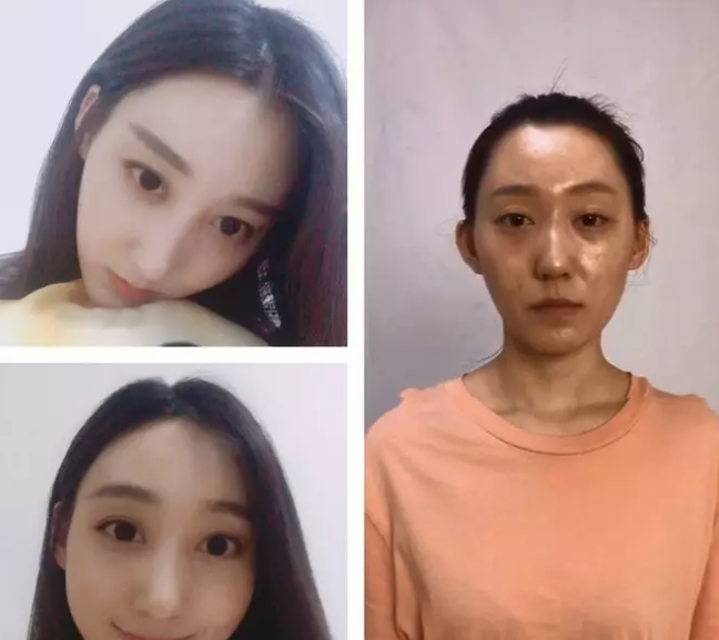 隆鼻手术