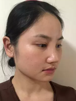 隆鼻手术