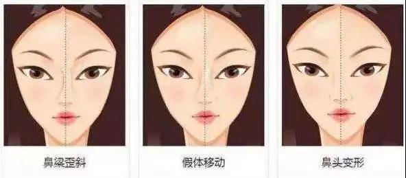 隆鼻手术