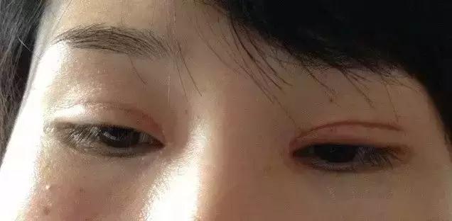 双眼皮手术