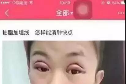 双眼皮手术