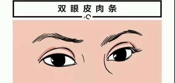 双眼皮手术