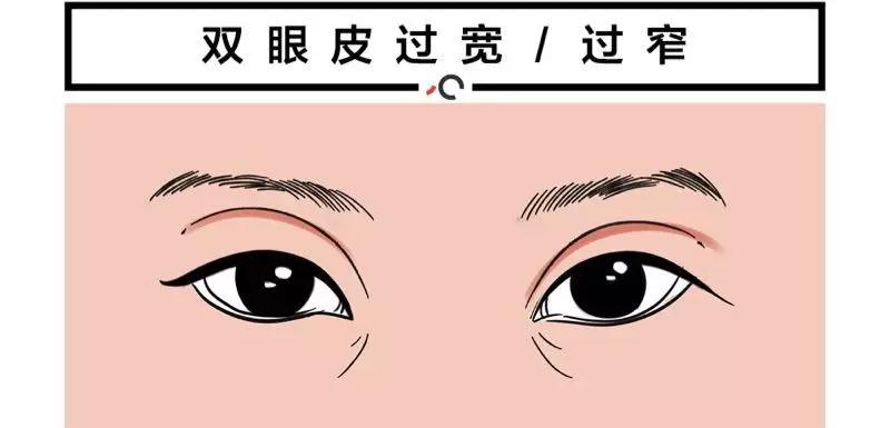 双眼皮手术