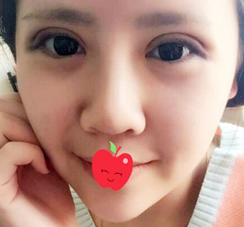 双眼皮手术