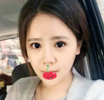 双眼皮手术