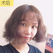双眼皮手术