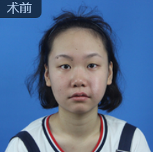 双眼皮手术
