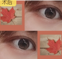 双眼皮手术