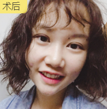 双眼皮手术
