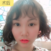 双眼皮手术