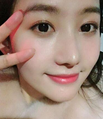 隆鼻手术
