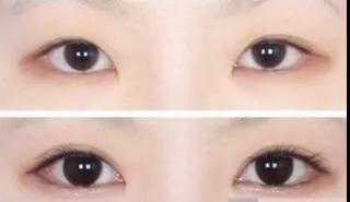 双眼皮手术