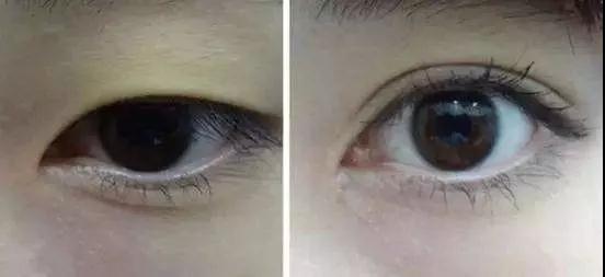 双眼皮手术
