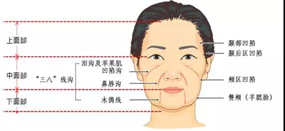 面部提升术