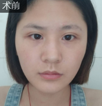 面部提升术