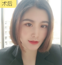 面部提升术