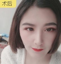 面部提升术