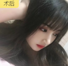双眼皮手术
