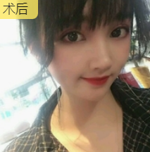 双眼皮手术