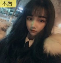 双眼皮手术