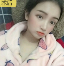 双眼皮手术