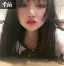 双眼皮手术
