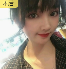 双眼皮手术