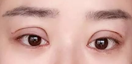 双眼皮手术