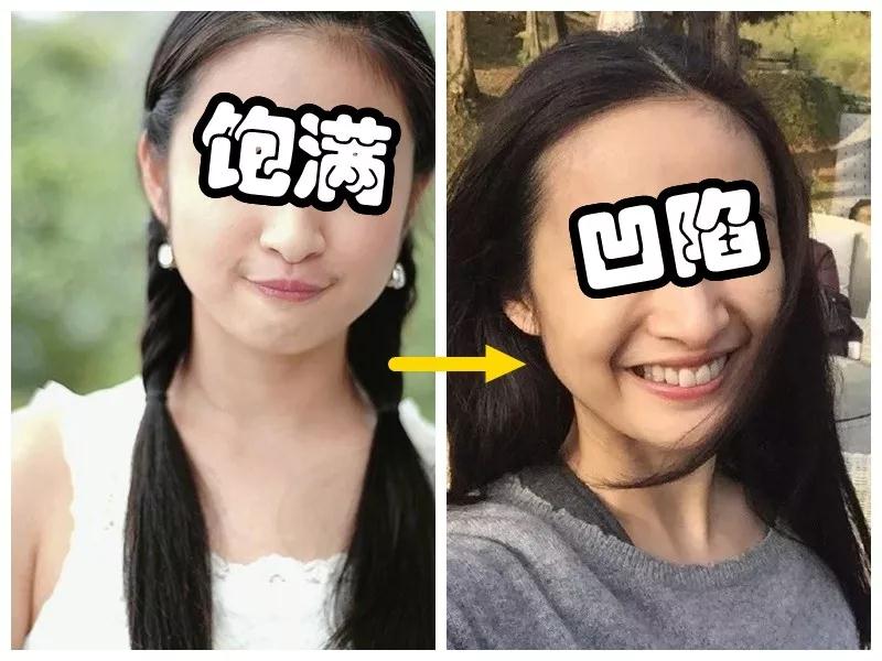 自体脂肪填充术