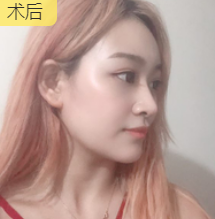面部提升术